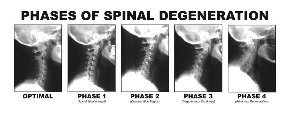 spinal degeneration chiropractic clinic stkilda 3183